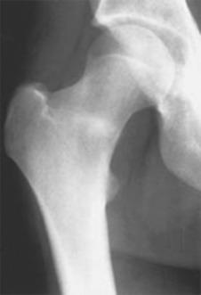 Fig. 10.2, An anteroposterior radiograph of the proximal femur showing a compression-side femoral neck fatigue fracture. Periosteal new bone formation is present in the inferior femoral neck, and healing endosteal callus formation is present in the inferior half of the femoral neck.