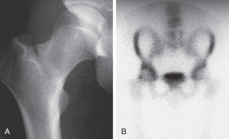 Fig. 10.3, (A) An anteroposterior radiograph with tension-side cortical disruption and propagation of the fracture across the femoral neck. (B) Magnetic resonance imaging with uptake on the superior (tension) side of the right femoral neck.