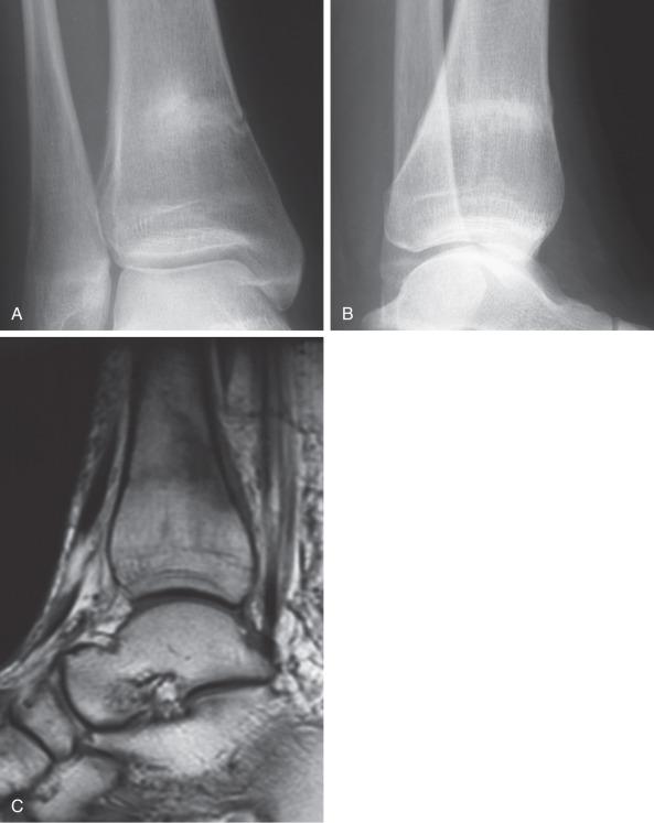 Fig. 10.4, (A and B) This tibial stress fracture is incomplete medial to lateral, but cortical disruption facilitates the diagnosis. (C) Magnetic resonance imaging demonstrates the lesion with high sensitivity.