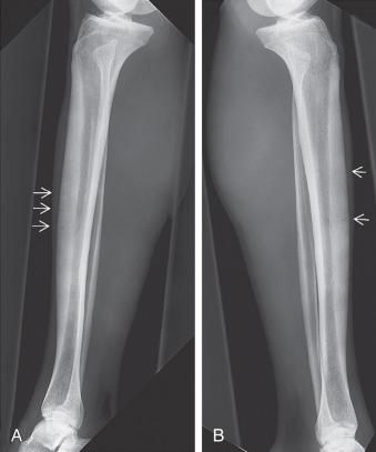 Fig. 10.5, (A and B) Radiographs of both tibiae showing multiple wedge-shaped fractures of the anterior cortex of the midtibia, the “dreaded black lines,” indicating high-risk tension-side stress fractures (arrows) .
