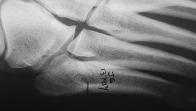 Fig. 10.6, An acute Jones fracture at the diaphyseal-metaphyseal junction of the fifth metatarsal.