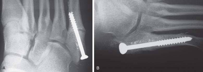 Fig. 10.7, Images of an 18-year-old collegiate soccer player with recurrent pain and nonunion of a Jones fracture after previous surgery. (A) Note the hypertrophic beaking and sclerosis at the fracture site. (B) Healing was achieved 10 weeks after revision intramedullary fixation and bone grafting.