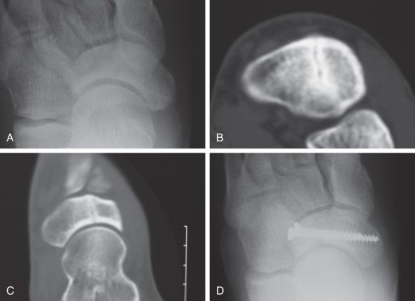 Fig. 10.8, A navicular stress fracture.