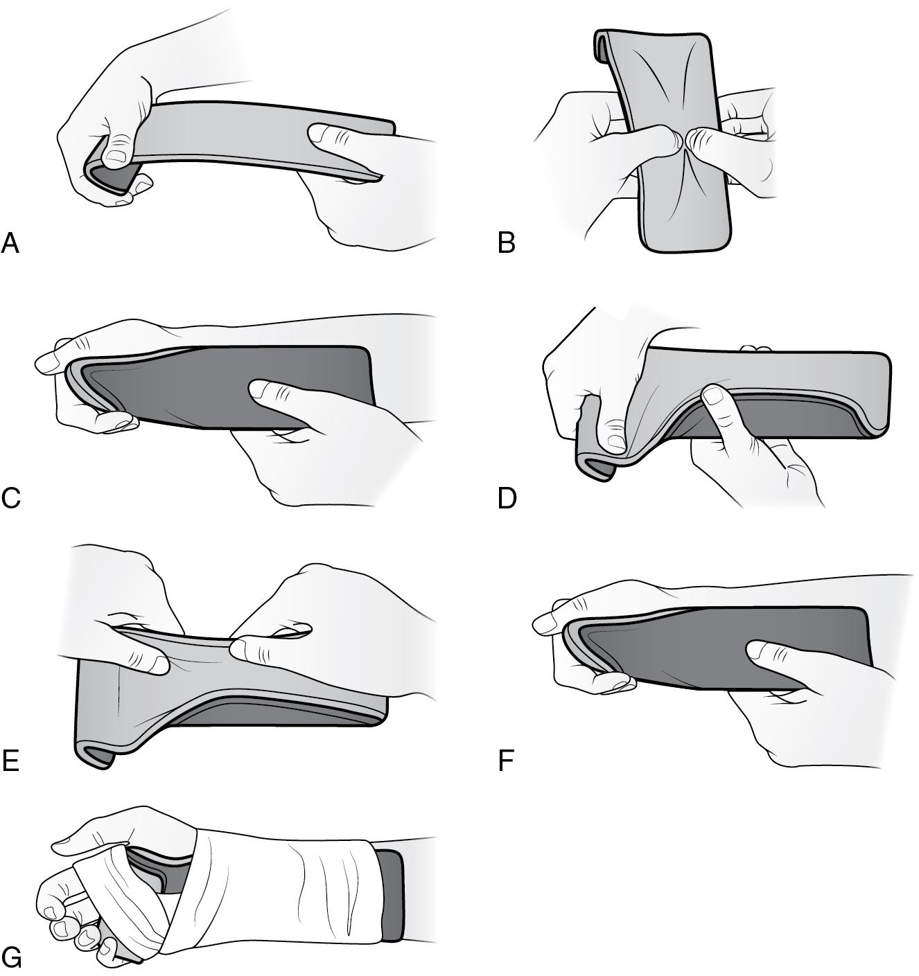 Fig. 314, SAM Splint volar wrist splint.