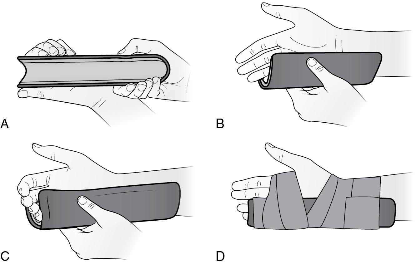 Fig. 316, SAM Splint ulnar gutter splint.