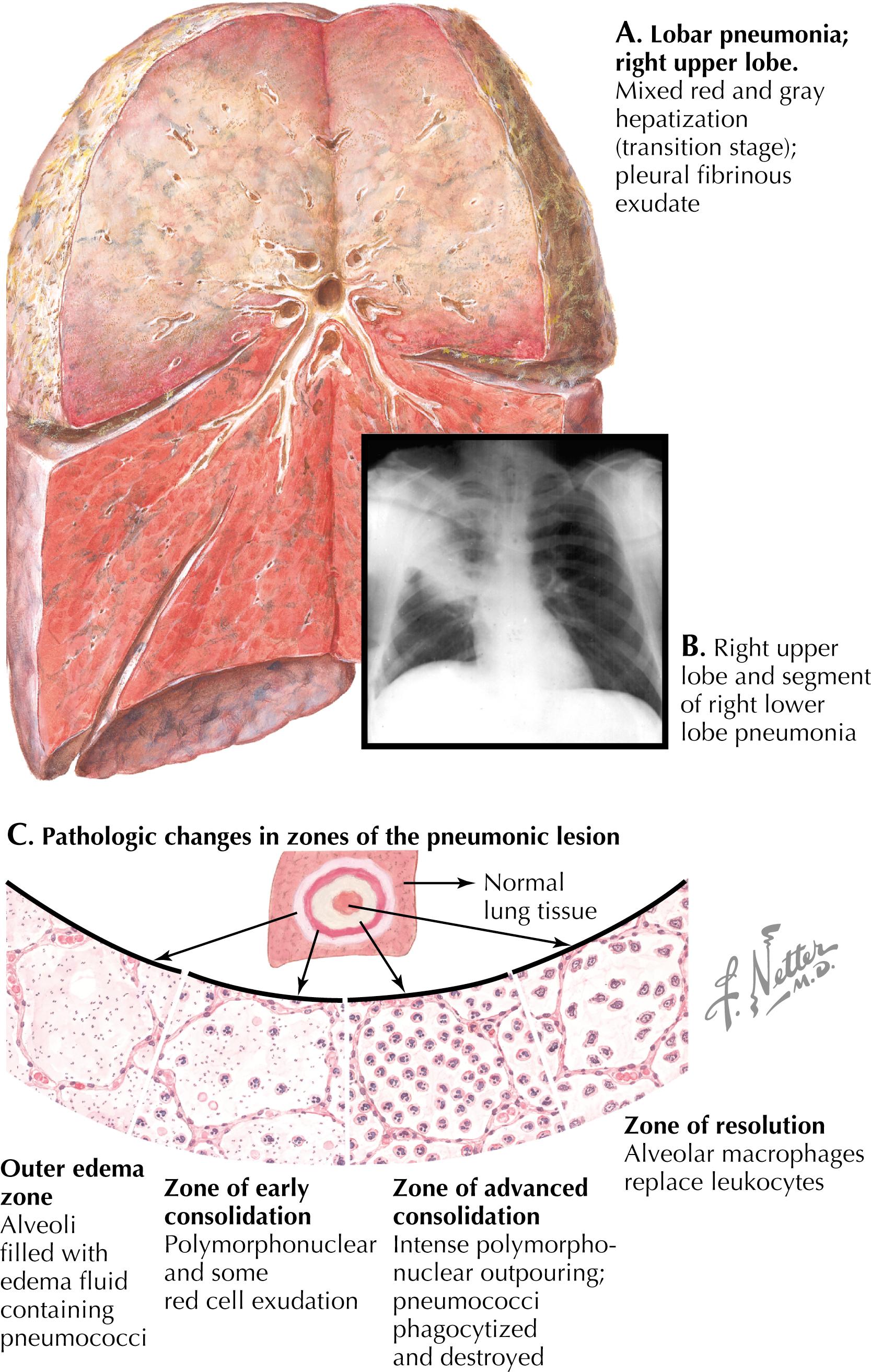 Fig. 26.1, Pneumococcal pneumonia.