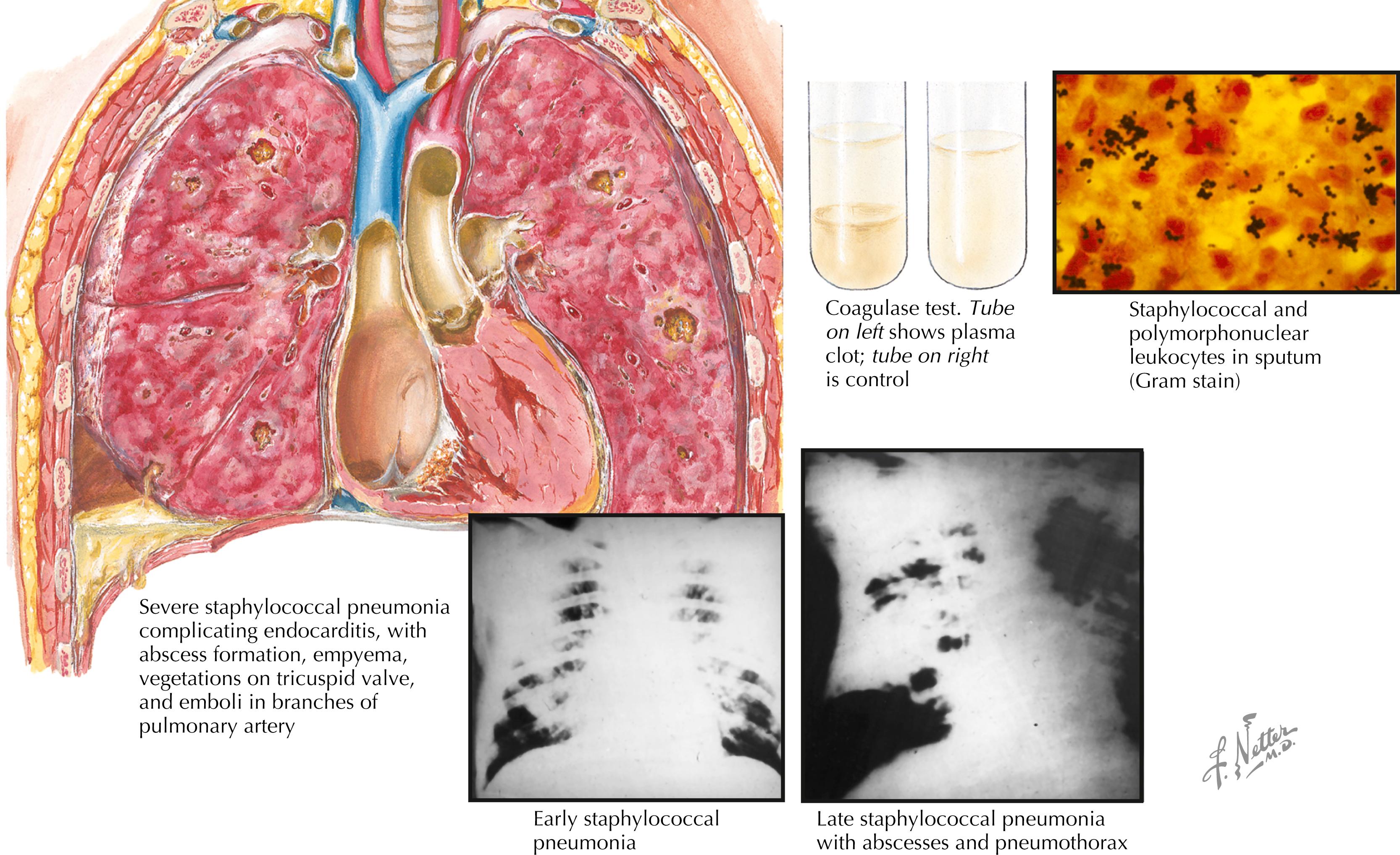 Fig. 26.2, Staphylococcal pneumonia.