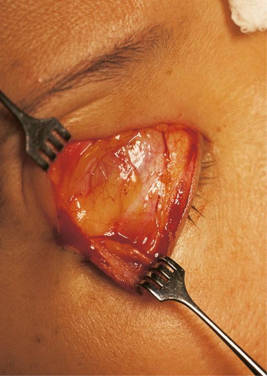 FIGURE 3-11, The presence of pretarsal fat pads within pretarsal orbicularis oculi muscle in an Asian upper lid without a crease.