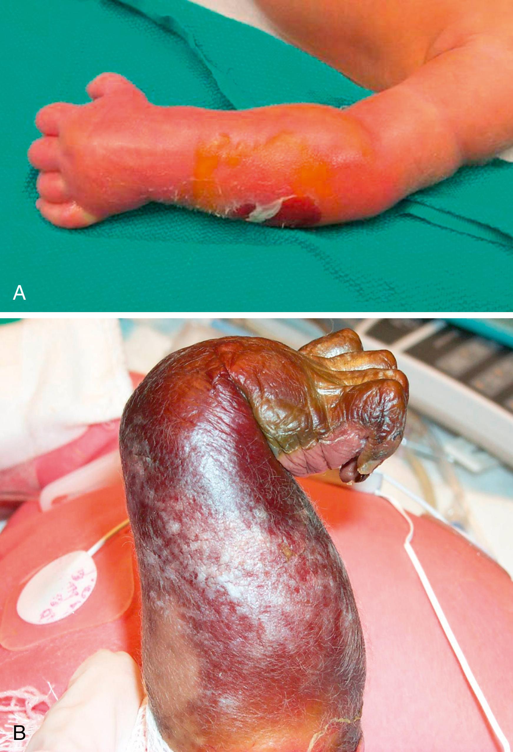 Fig. 51.1, A, Neonatal compartment syndrome. Note the hallmark sentinel lesion at the lateral proximal forearm. B, Neonatal Volkmann’s contracture. The entire forearm is necrotic. This patient underwent amputation at the proximal forearm.