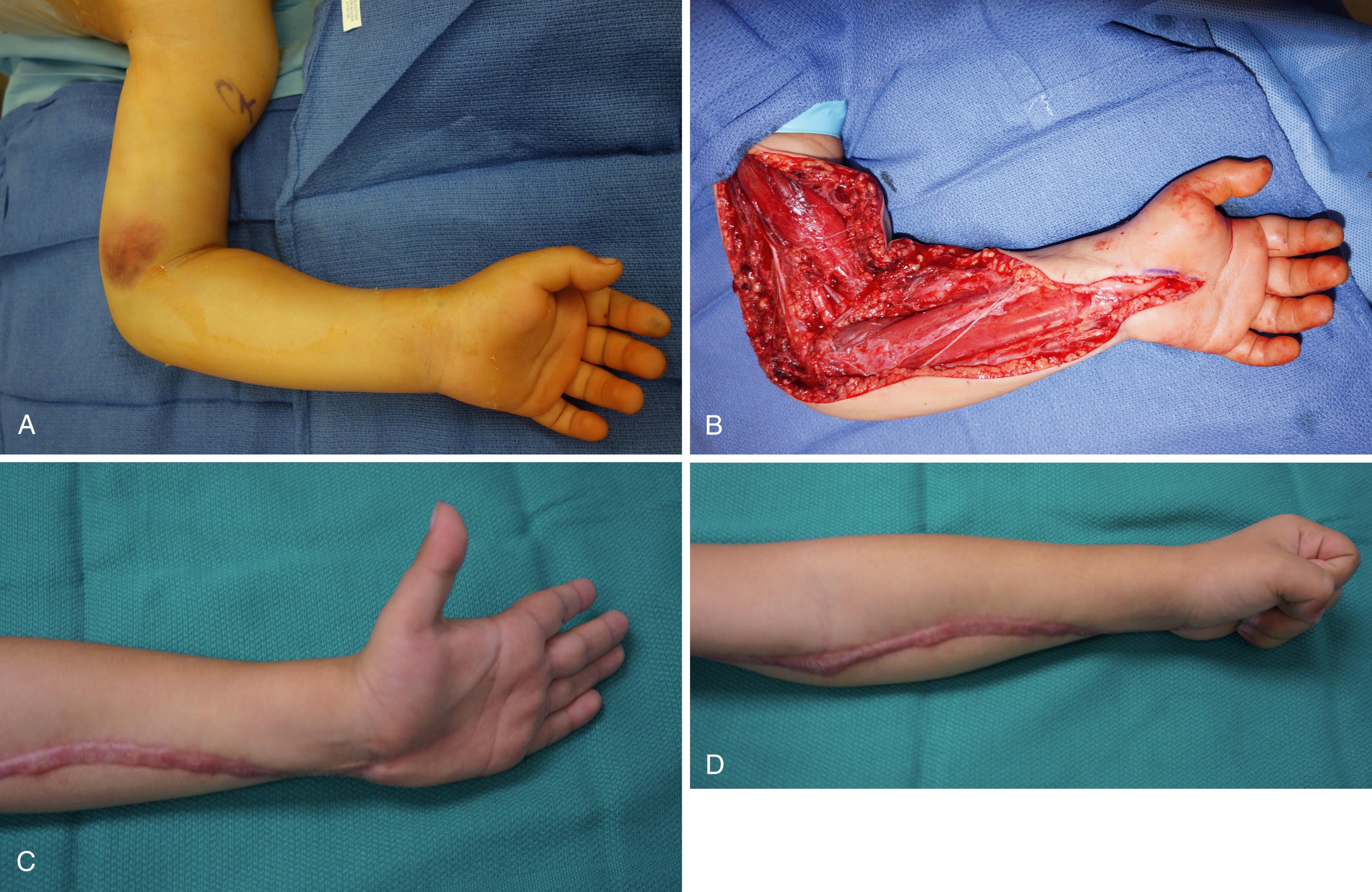 Fig. 51.7, This 5-year-old patient sustained a type III 100% displaced supracondylar humerus fracture that was treated with closed reduction and pinning. Approximately 6 hours after surgery, the patient had increased pain and analgesia requirements. On examination, the compartments were tense and swollen. He was taken emergently for fasciotomy of the arm and forearm. A, Appearance of the arm after closed reduction and pinning after patient returned to the operating room. B, Fasciotomy of the arm and forearm. C, Final finger and wrist extension after 6 months. D, Final finger flexion after 6 months.