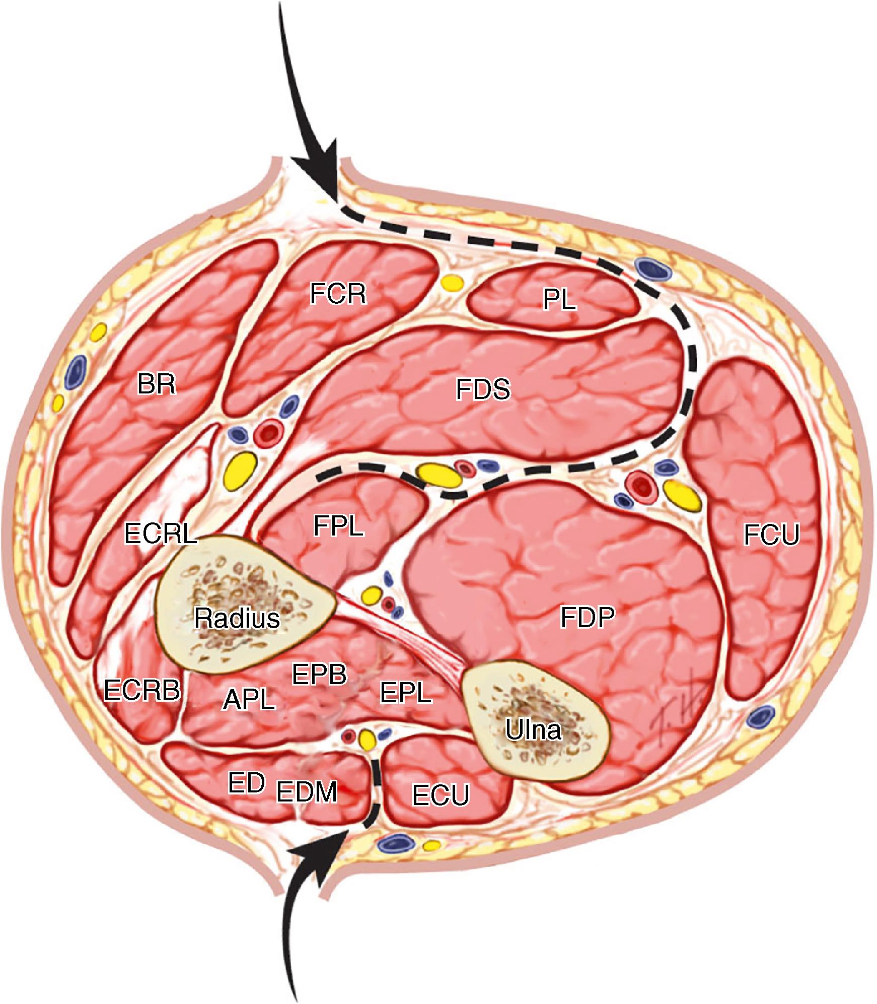 Fig. 51.8, Cross section of the midforearm with arrows showing the plane of dissection for decompression of the superficial and deep flexor compartments of the volar forearm and the dorsal forearm. APL, Abductor pollicis longus; BR, brachioradialis; ECRB, extensor carpi radialis brevis; ECRL, extensor carpi radialis longus; ECU, extensor carpi ulnaris; ED , extensor digitorum communis; EDM, extensor digiti minimi; EPB, extensor pollicis brevis; EPL, extensor pollicis longus; FCR, flexor carpi radialis; FCU, flexor carpi ulnaris; FDP, flexor digitorum profundus; FDS, flexor digitorum superficialis; FPL, flexor pollicis longus; PL, palmaris longus.