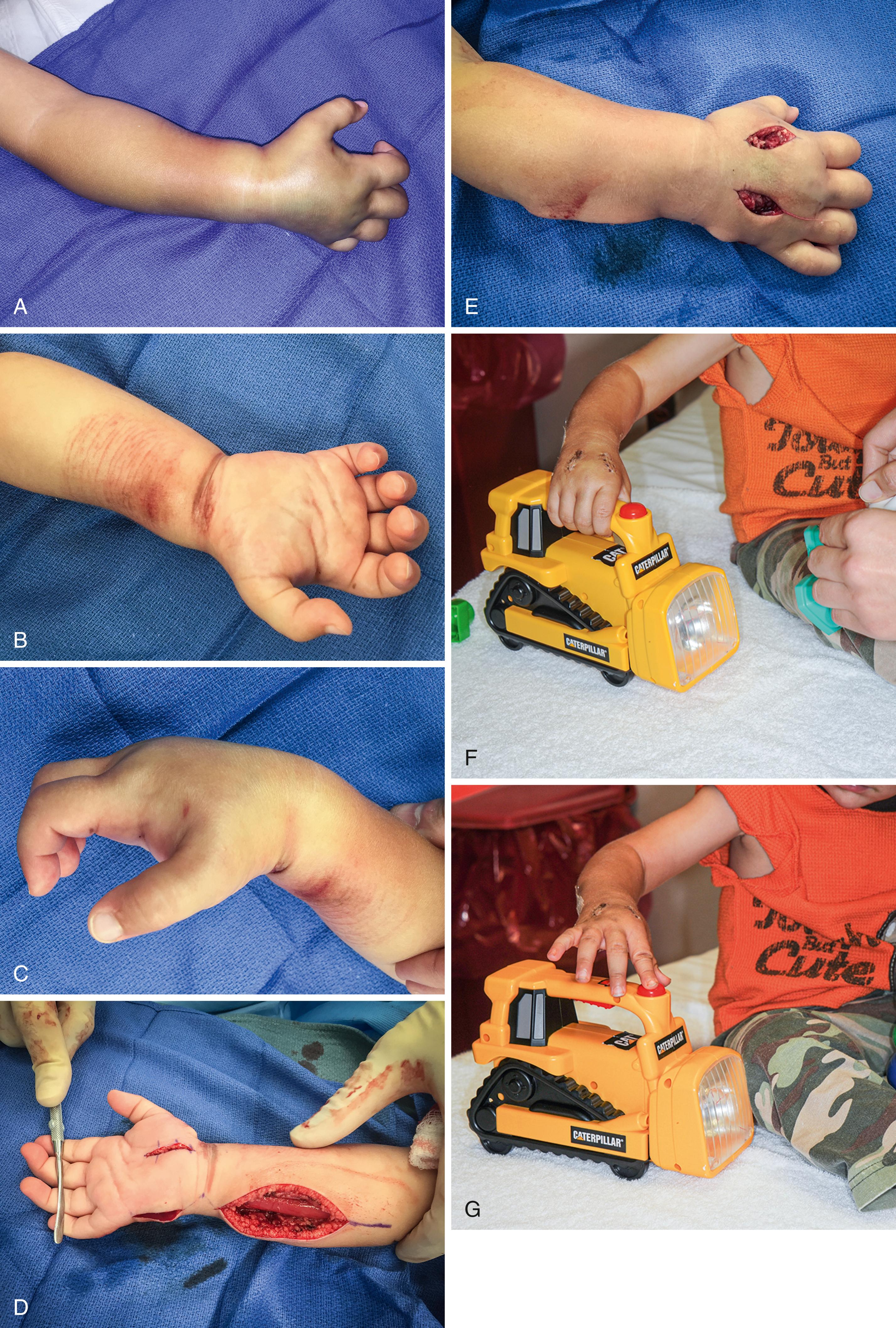 Fig. 51.9, An 18-month-old child presented 5 hours after the right forearm inadvertently caught in a clothes wringer. The child was in extreme pain and inconsolable. A, Right forearm markedly swollen and tense. B, Volar skin abrasions from wringer. C, Intrinsic minus hand posture. D, Ulnar incision for fasciotomy with separate carpal tunnel incision. E, Hand fasciotomy. F, Early recovery of grasp. G, Digital extension and subsequent full recovery.