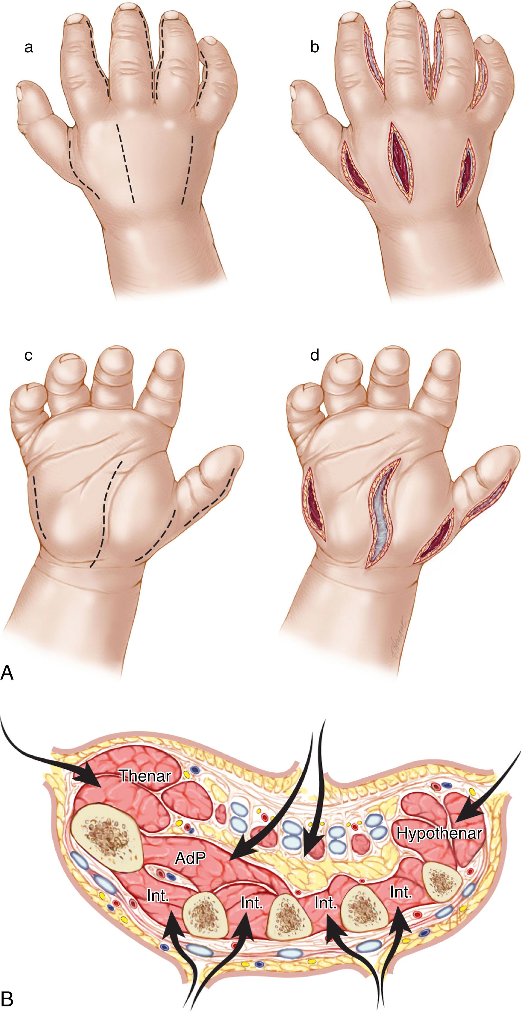 Fig. 51.10, A, Incisions for decompression of the hand. B, Cross section of the midhand showing planes of dissection for surgical decompression. AdP, Adductor pollicis; Int., interosseous muscles.