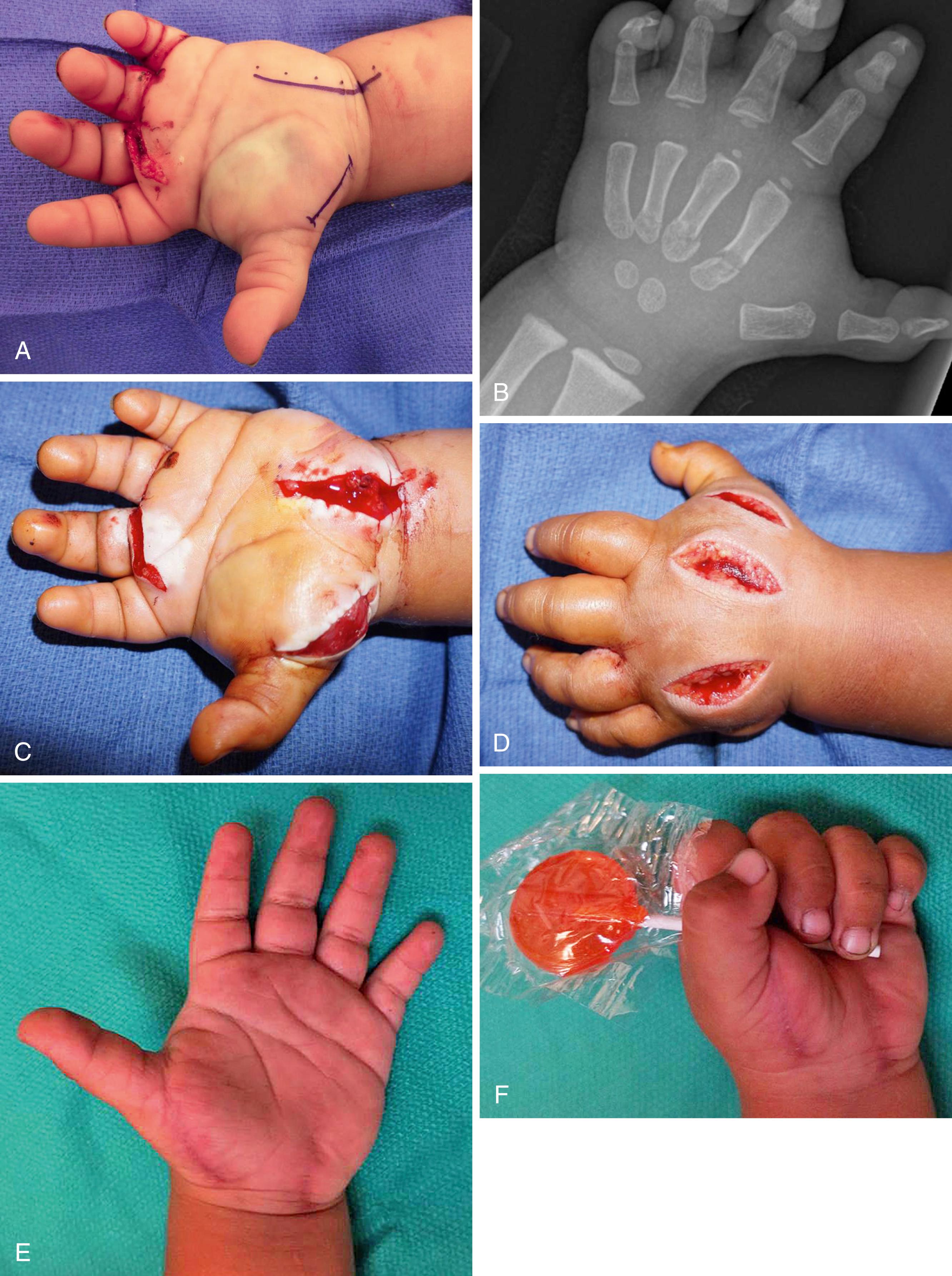 Fig. 51.11, A 2-year-old sustained a crush injury to his left hand, with fractures of the second to fourth metacarpal bases and an open wound at the volar metacarpal heads. He presented with a tense swollen hand. He was taken emergently for fasciotomies of the hand and underwent percutaneous pinning of the displaced metacarpal base fractures. A, Appearance of the hand at presentation. B, Metacarpal base fractures, 100% displaced in the sagittal plane. C, Fasciotomies of the volar hand. D, Fasciotomies of the dorsal hand. E, Final extension at 9 months following injury. F, Final flexion at 9 months following injury.