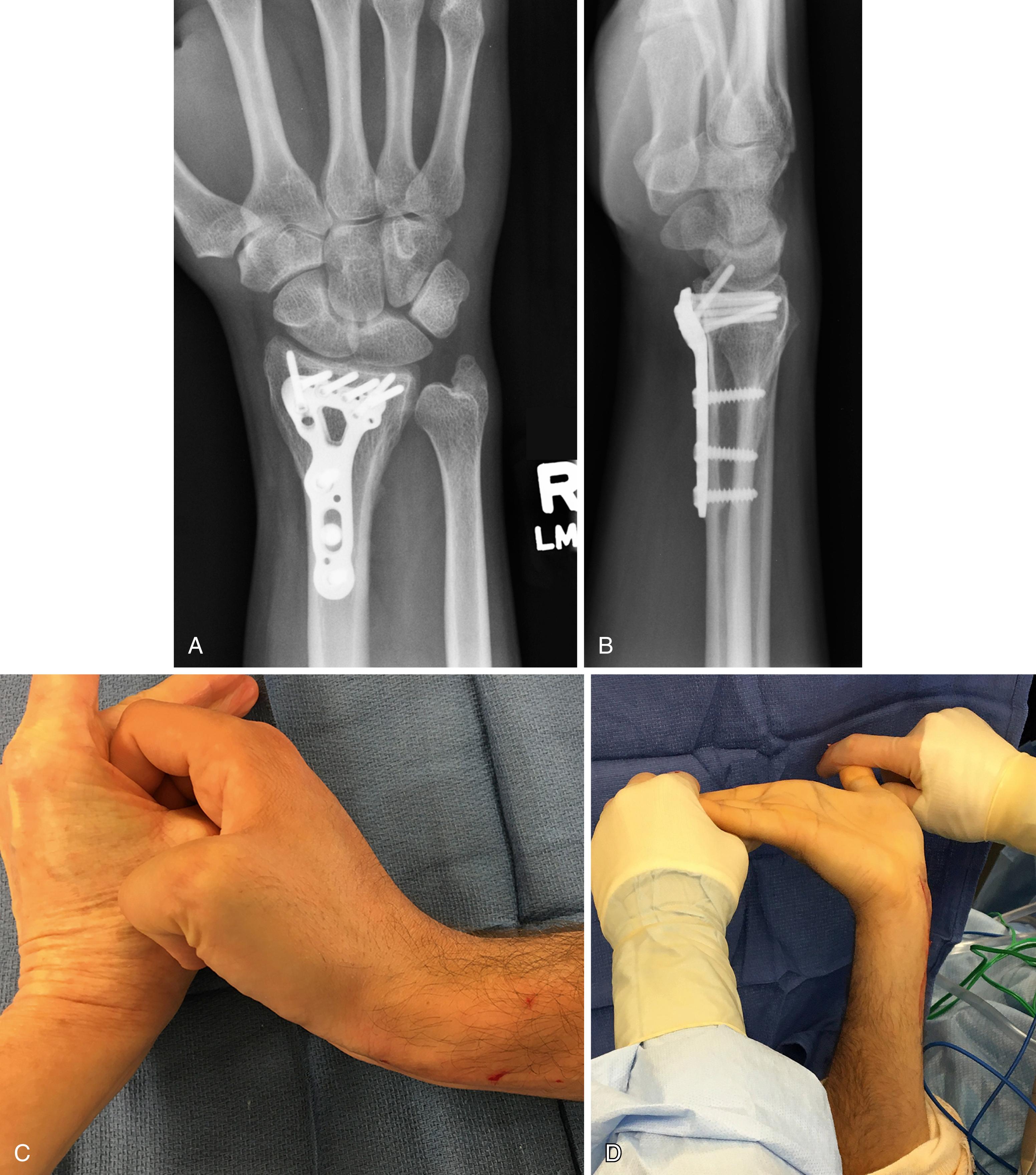 eFig. 51.1, Pseudo-Volkmann’s contracture. A and B, Preoperative imaging injury. C, Preoperative passive finger extension with wrist in neutral. D, Intraoperative full passive extension of wrist and fingers.