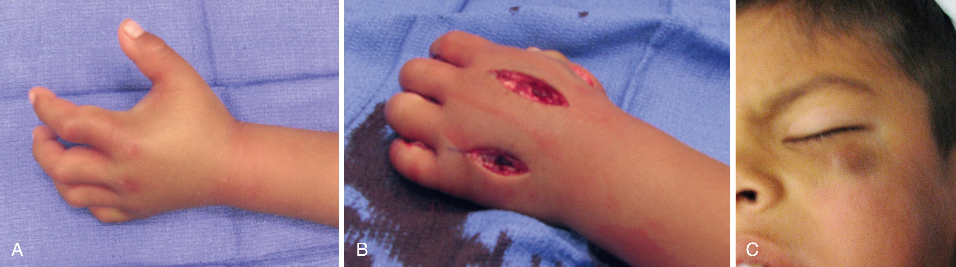 Fig. 51.2, This 4-year-old presented with hand and forearm swelling after minor trauma. Other areas of bruising were noted. After workup, the child was found to have hemophilia A. He underwent fasciotomy of his hand and forearm. A, Swelling of the hand and forearm. B, After dorsal fasciotomy of the hand and volar extended carpal tunnel release and forearm fasciotomy. C, Bruising of the periorbital region.