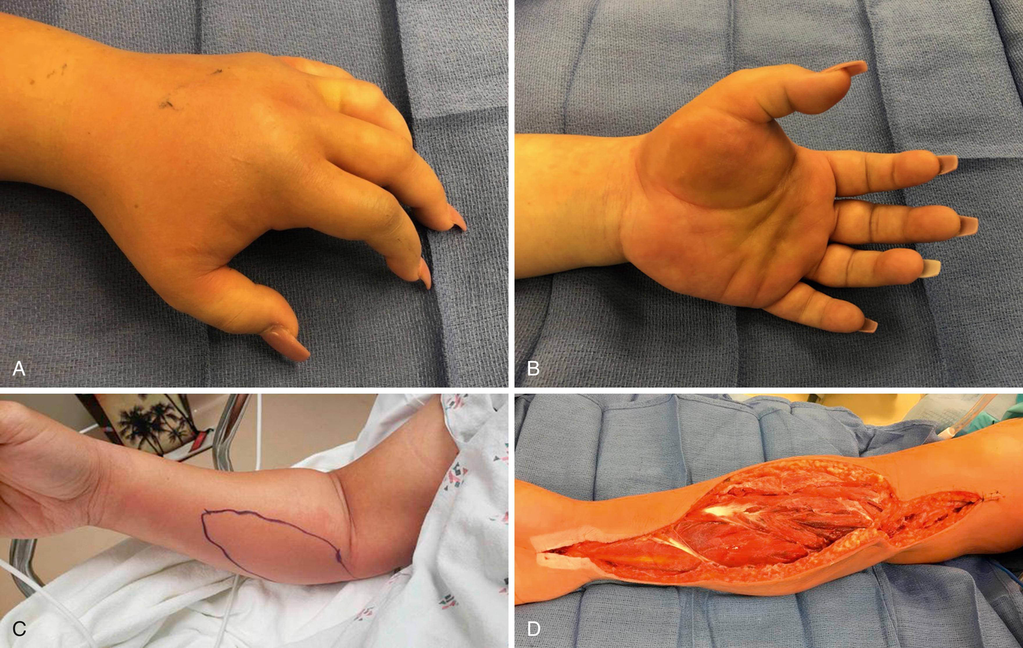 eFig. 51.2, A and B, Patient 1: hand compartment syndrome due to group A streptococcal infection. C and D, Patient 2: forearm compartment syndrome due to group A streptococcal infection (GAS).