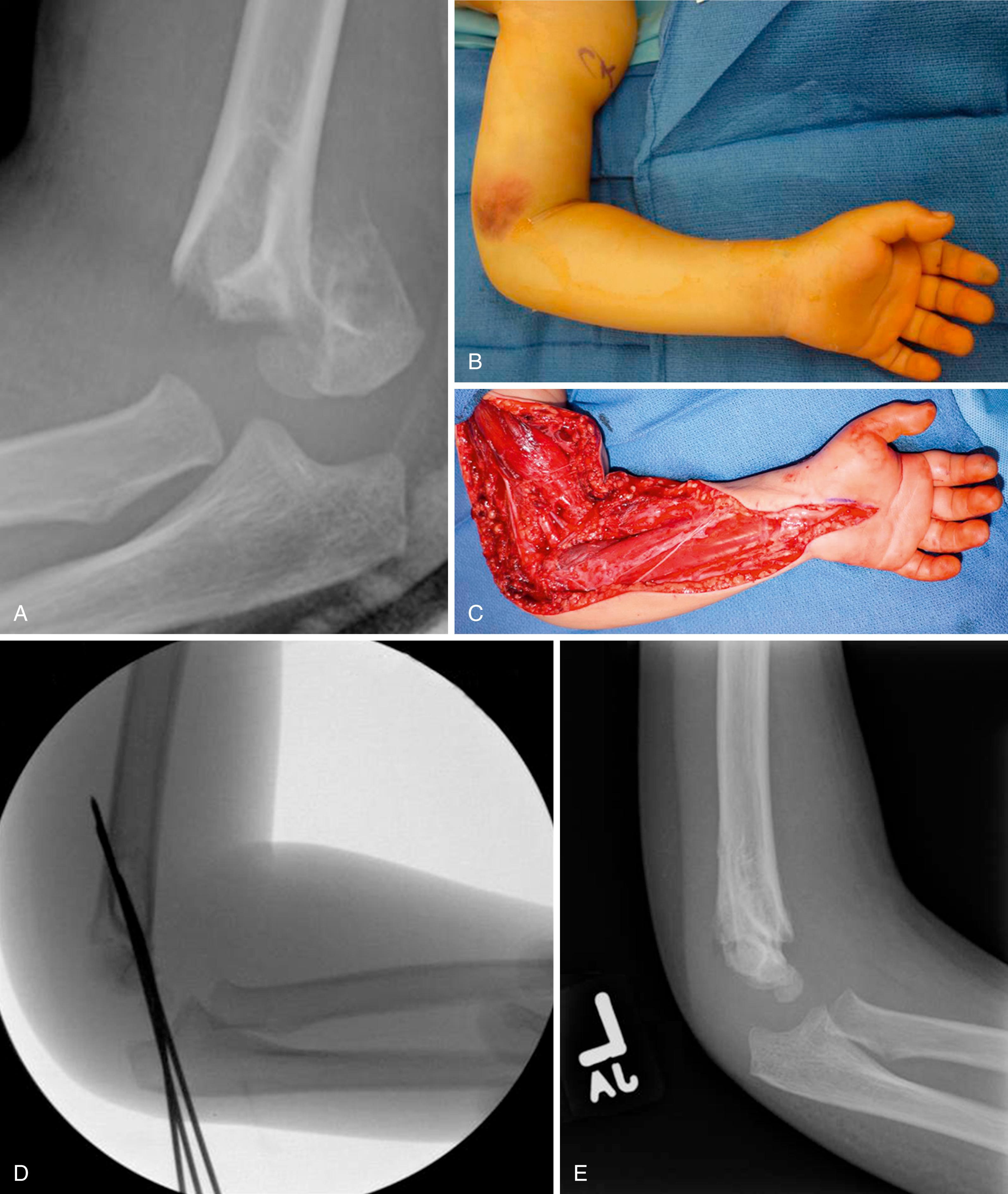 eFig. 51.3, Supracondylar humerus fracture. A, Gartland 4 SCH fracture. B, Clinical appearance at presentation. C, Intraoperative S/P fasciotomy. D, Intraoperative stabilization. E, Lateral radiograph at 1 year. F to I, Clinical outcome at 5 years.
