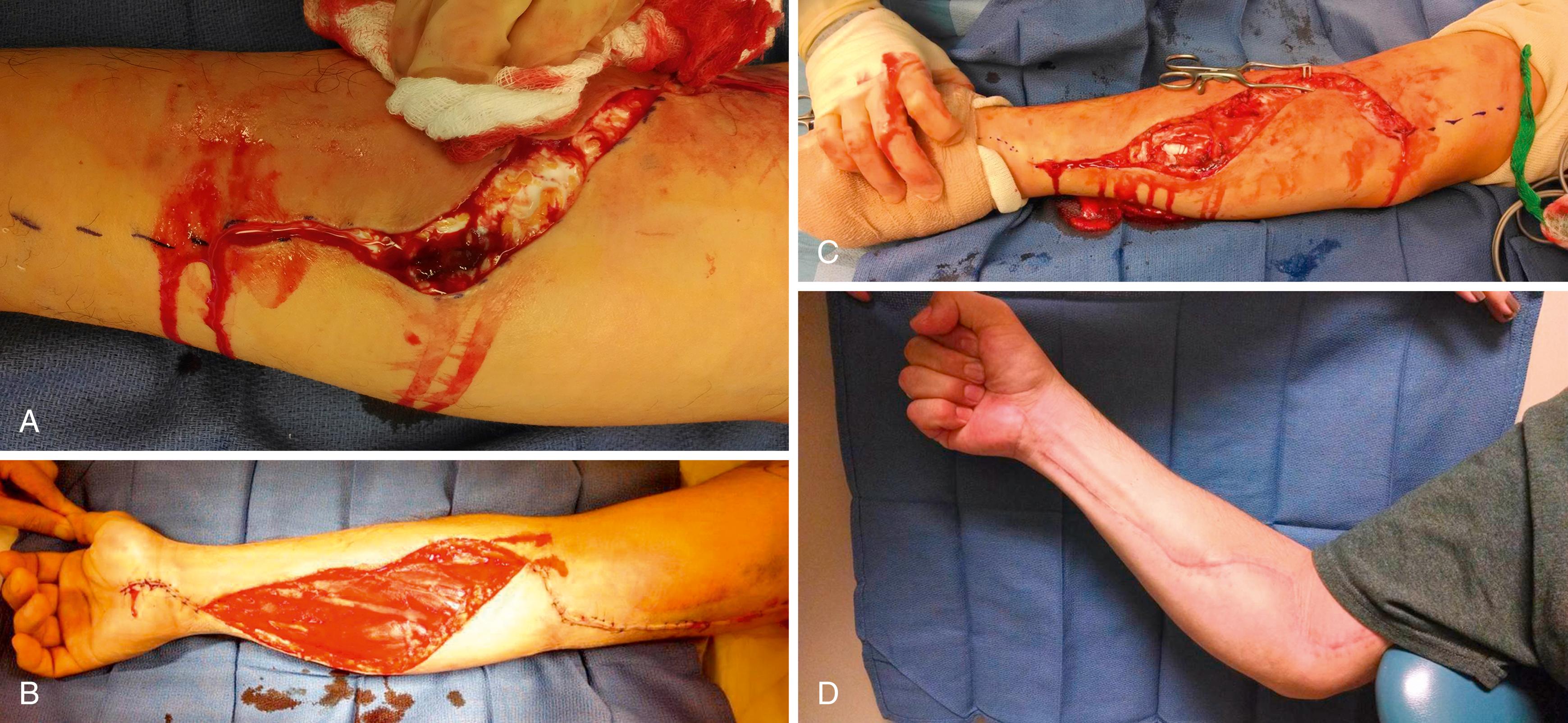 eFig. 51.4, Extravasation of the right upper extremity. Immediate fasciotomy ( A and B ) and partial wound closure (C) . D, Wound healing at 8 weeks.
