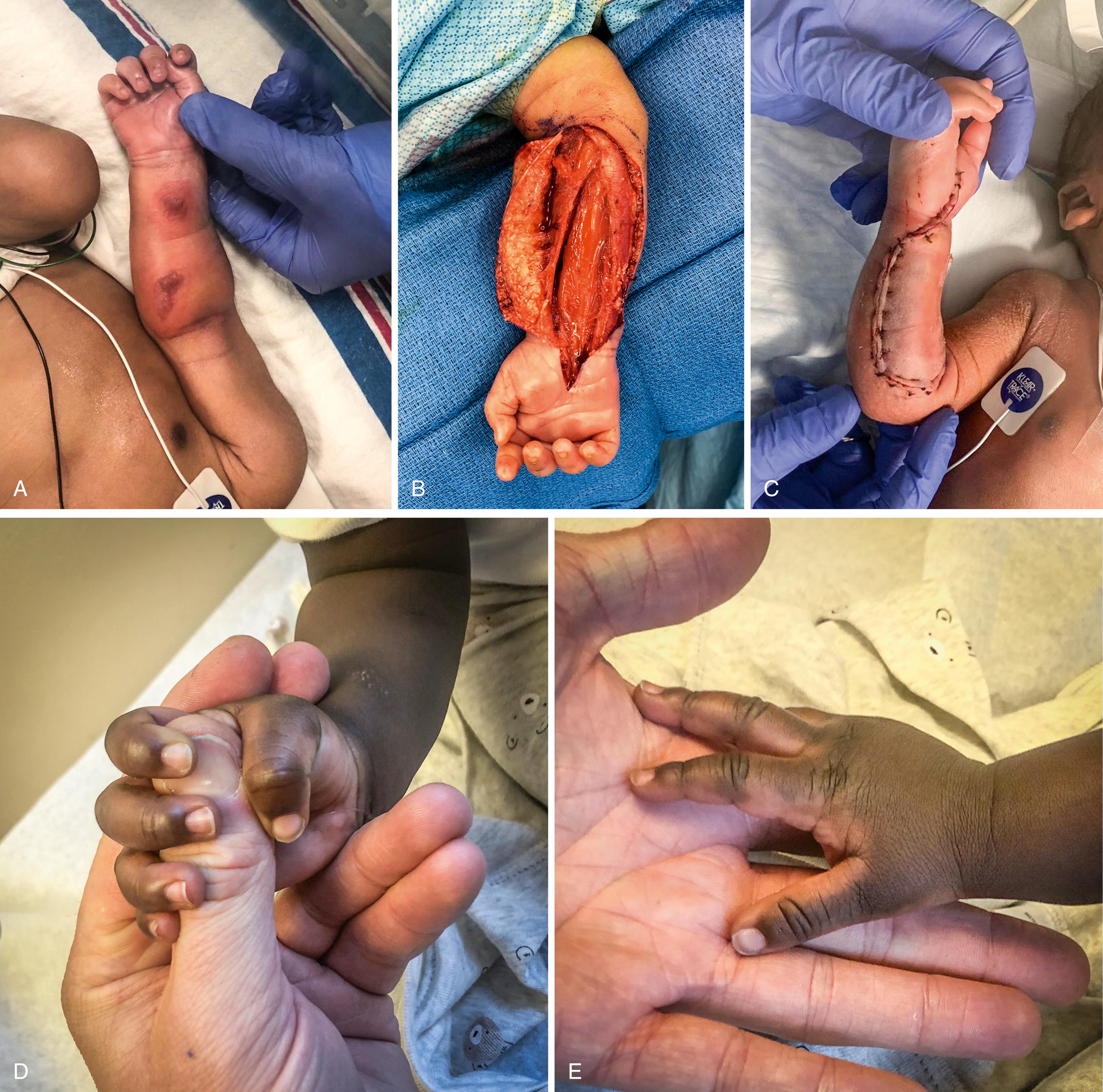 Fig. 51.4, Neonate born via Caesarian section due to compound presentation with diffuse circumferential swelling and erythema about his right forearm. Previous consultations obtained from neurology, infectious disease, and general surgery without a definitive diagnosis. Hand surgery service consulted at 22 hours of life and immediately diagnosed neonatal compartment syndrome. A, Clinical picture of right forearm swelling and volar sentinel lesions. B, Immediate fasciotomy. C, Closure. D, Recovery of grip. E, Digital extension and subsequent full recovery.