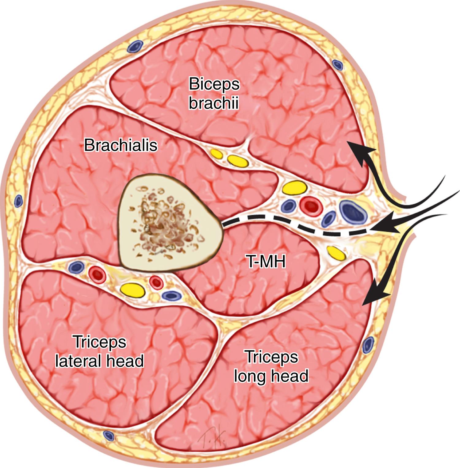 Fig. 51.5, Cross section of the midarm with arrows showing the plane of dissection for decompression of the anterior and posterior compartments. Alternatively, separate anterior and posterior incisions can be used. T-MH, Triceps, medial head.