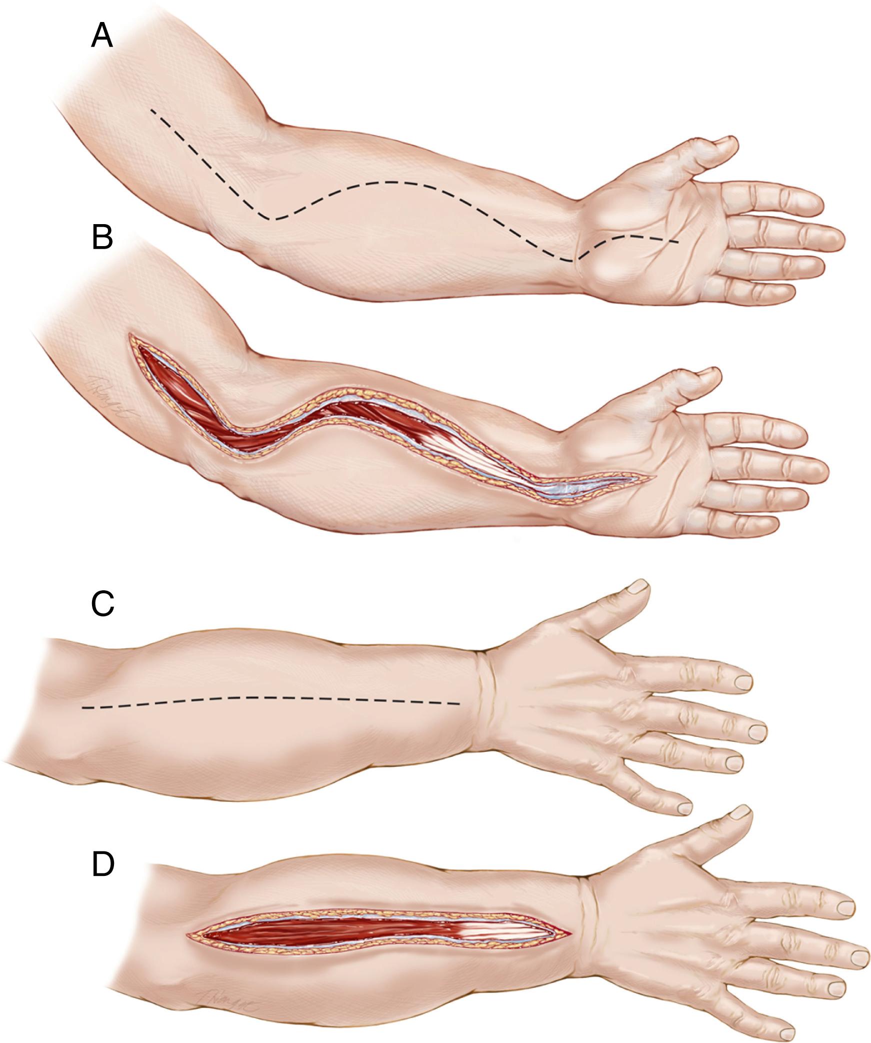 Fig. 51.6, Extensile incision for decompression of the forearm: The incision can be extended proximally to decompress the arm and distally into the carpal tunnel. A, Line of skin incision for volar release. B, Volar incision opened from the midarm to the carpal tunnel. C, Line of the dorsal incision. D, Dorsal incision opened and fascia released.