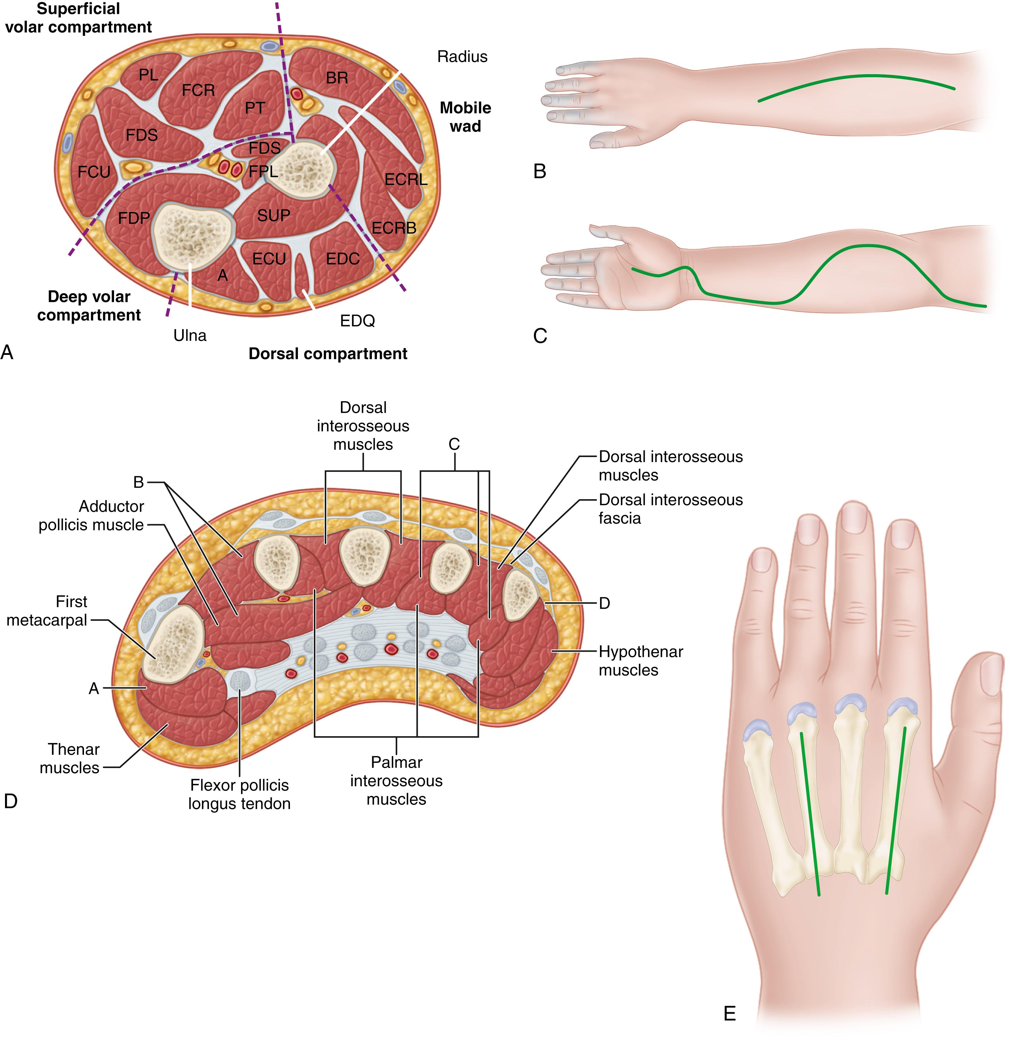 Fig. 51.1, (A) Cross-section through upper third of forearm. A , anconeus muscle; BR , brachioradialis; ECRB , extensor carpi radialis brevis; ECRL , extensor carpi radialis longus; ECU , extensor carpi ulnaris; EDC , extensor digitorum communis; EDQ , extensor digiti quinti; FCR , flexor carpi radialis; FCU , flexor carpi ulnaris; FDP , flexor digitorum profundus; FDS , flexor digitorum sublimis; FPL , flexor pollicis longus; PL , palmaris longus; PT , pronator teres; SUP , supinator. (B) Extensive opening of fascia of the forearm dorsum in dorsal compartment syndromes. (C) Incision used for anterior forearm compartment syndromes in which skin and underlying fascia are released completely throughout. (D) Cross-section through hand. Dorsal and volar interosseous compartments and adductor compartment to thumb (B and C in illustration); thenar and hypothenar compartments (A and D in illustration). (E) Longitudinal incisions over second and third metacarpals.