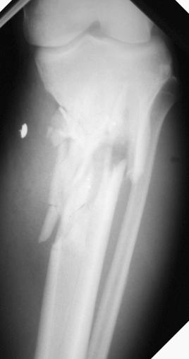 Fig. 17.1, This radiograph shows a comminuted proximal tibia fracture resulting from a gunshot wound. This type of high-energy injury has a high risk of developing acute compartment syndrome.