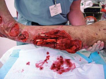 Fig. 17.13, This image demonstrates the extent of soft tissue damage that is typically encountered with combat wounds.