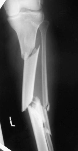 Fig. 17.3, This radiograph shows a segmental tibial shaft and fibula fracture. This type of high-energy injury has a high risk of developing acute compartment syndrome.