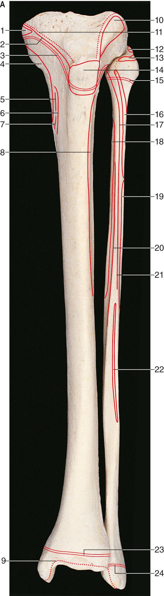 Fig. 84.1, The muscle attachments of the left tibia and fibula. A , Anterior aspect. Key: 1, semimembranosus; 2, medial patellar retinaculum; 3, epiphysial line (growth plate); 4, tibial collateral ligament; 5, gracilis; 6, sartorius; 7, semitendinosus; 8, tibialis anterior; 9, capsular attachment; 10, iliotibial tract; 11, capsular attachment; 12, fibular collateral ligament; 13, biceps femoris; 14, patellar ligament; 15, epiphysial line (growth plate); 16, fibularis longus; 17, extensor digitorum longus; 18, tibialis posterior; 19, fibularis brevis; 20, extensor hallucis longus; 21, extensor digitorum longus; 22, fibularis tertius; 23, epiphysial line (growth plate); 24, epiphysial line (growth plate). B , Posterior aspect. Key: 1, gap in capsule for popliteus tendon; 2, soleus; 3, flexor hallucis longus; 4, fibularis brevis; 5, epiphysial line (growth plate); 6, capsular attachment; 7, semimembranosus; 8, epiphysial lines (growth plates); 9, popliteus; 10, soleus; 11, tibialis posterior; 12, flexor digitorum longus; 13, epiphysial line (growth plate); 14, capsular attachment.