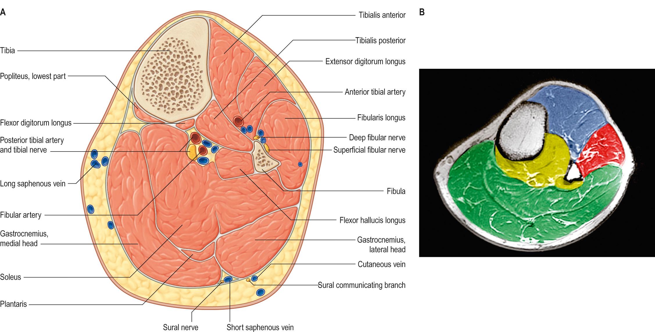 Fig. 84.2, A , A transverse (axial) section through the left leg, approximately 10 cm distal to the knee joint. B , Colour-coded axial MRI of the leg. Note the anterior (blue), lateral (red) and posterior (deep part yellow and superficial part green) compartments of the leg.