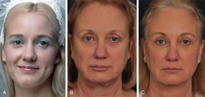 Figure 25.2, (A) Patient photo from when she was in her twenties demonstrating a fuller and more youthful upper eyelid. (B). Preoperative photo of this patient in her sixties demonstrating periorbital volume loss. The upper eyelid is characterized by an “A”-frame deformity with predominantly medial volume loss. (C). One year postoperative photo following autologous fat transfer to the inferior and superior orbital rims and midface in conjunction with upper eyelid blepharoplasty and facelift.