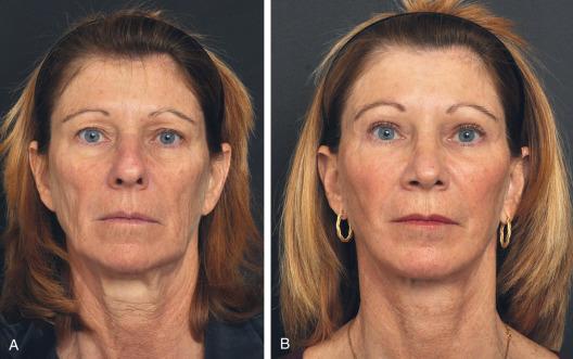 Figure 25.3, Preoperative (A) and 1-year postoperative (B) photos of a patient who underwent autologous fat transfer to the inferior and superior orbital rims and midface in conjunction with upper eyelid blepharoplasty and facelift.