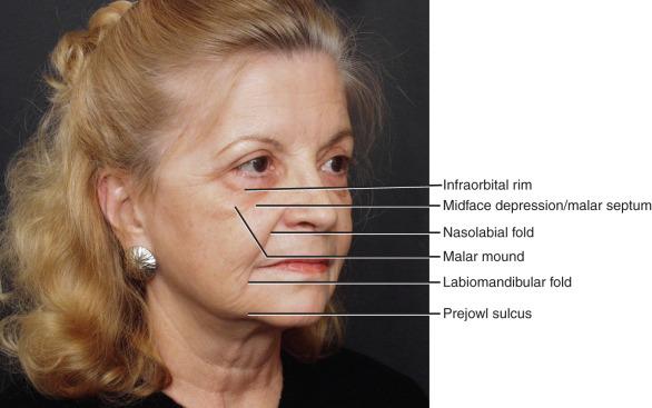 Figure 25.4, The important anatomic landmarks for fat injections are depicted in this photograph.