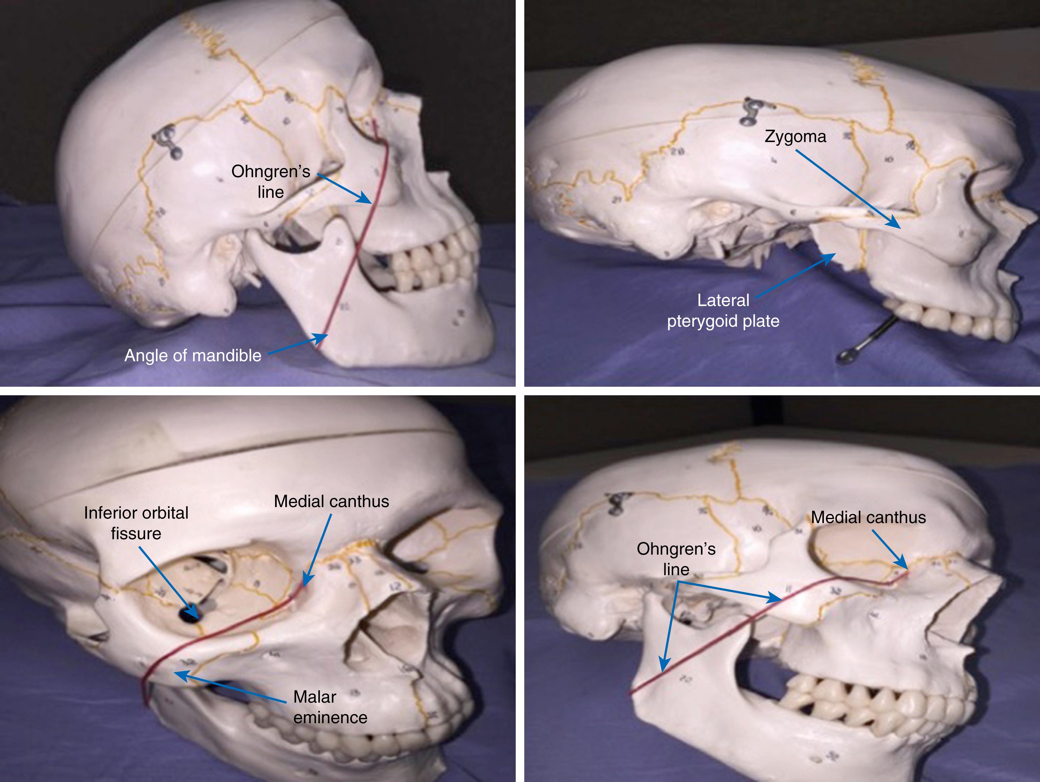 Fig. 107.2, Ohngren’s line.