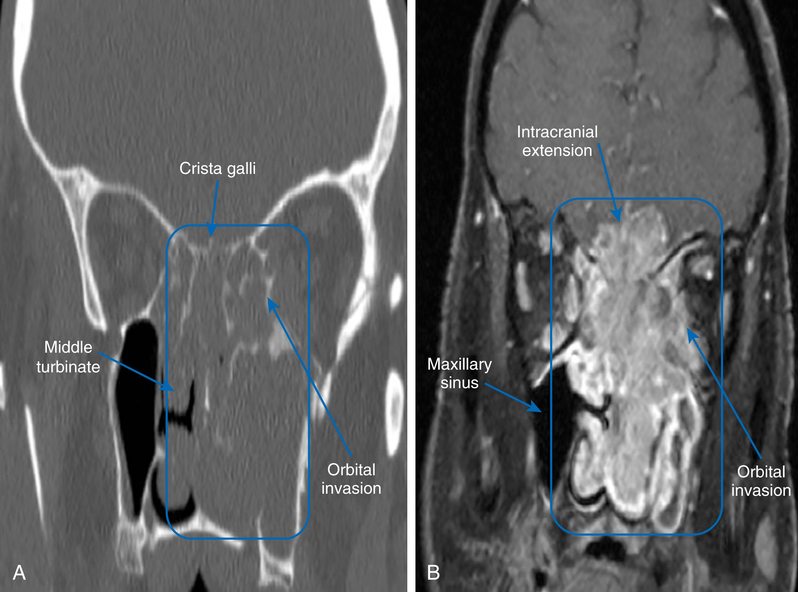 Fig. 107.1, Radiographic imaging of a maxillary sinus and skull base neoplasm.