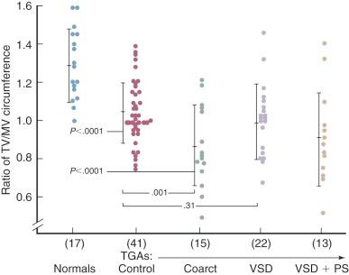 Figure 52-18, Ratio of tricuspid to mitral valve circumference in a series of autopsy hearts with transposition of great arteries (TGA) compared with 17 normal hearts. “Control” TGA specimens were those with a completely intact ventricular septum, with or without a small patent ductus arteriosus, atrial septal defect, or patent foramen ovale. Only unoperated specimens and those obtained within 30 days of an intracardiac repair are included. Vertical bars indicate one standard deviation. Individual P values are noted. Key: Coarct, Coarctation; PS, pulmonary stenosis; TV/MV, tricuspid to mitral valve; VSD, ventricular septal defect.