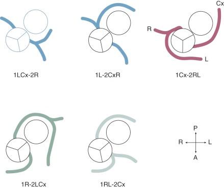 Figure 52-4, Most common patterns of circumflex coronary system when each facing sinus of Valsalva (sinuses 1 and 2) gives origin to a major coronary artery in hearts with transposition of great arteries. Key: Cx, Circumflex; L, left anterior descending coronary artery; R, right coronary artery.