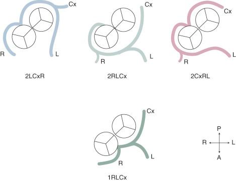 Figure 52-5, Origin of all three major coronary arteries from a single ostium (or a double-barreled ostium) in sinus 2 or sinus 1 in hearts with transposition of great arteries. Key: Cx, Circumflex; L, left anterior descending coronary artery; R, right coronary artery.