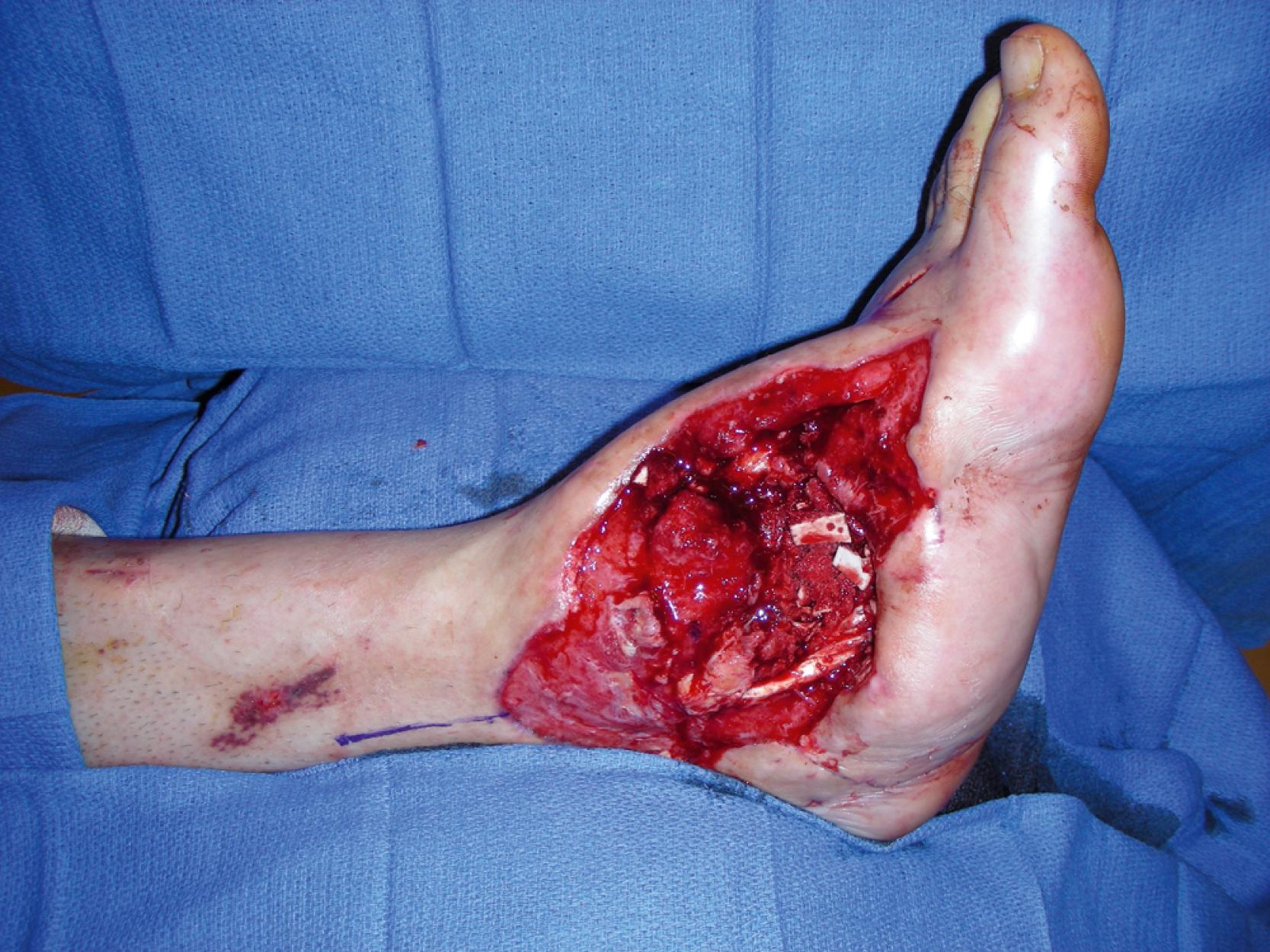 Fig. 49.1, A preoperative view showing a 15 × 8 cm complex soft tissue wound in the left medial ankle associated with underlying comminuted fractures.