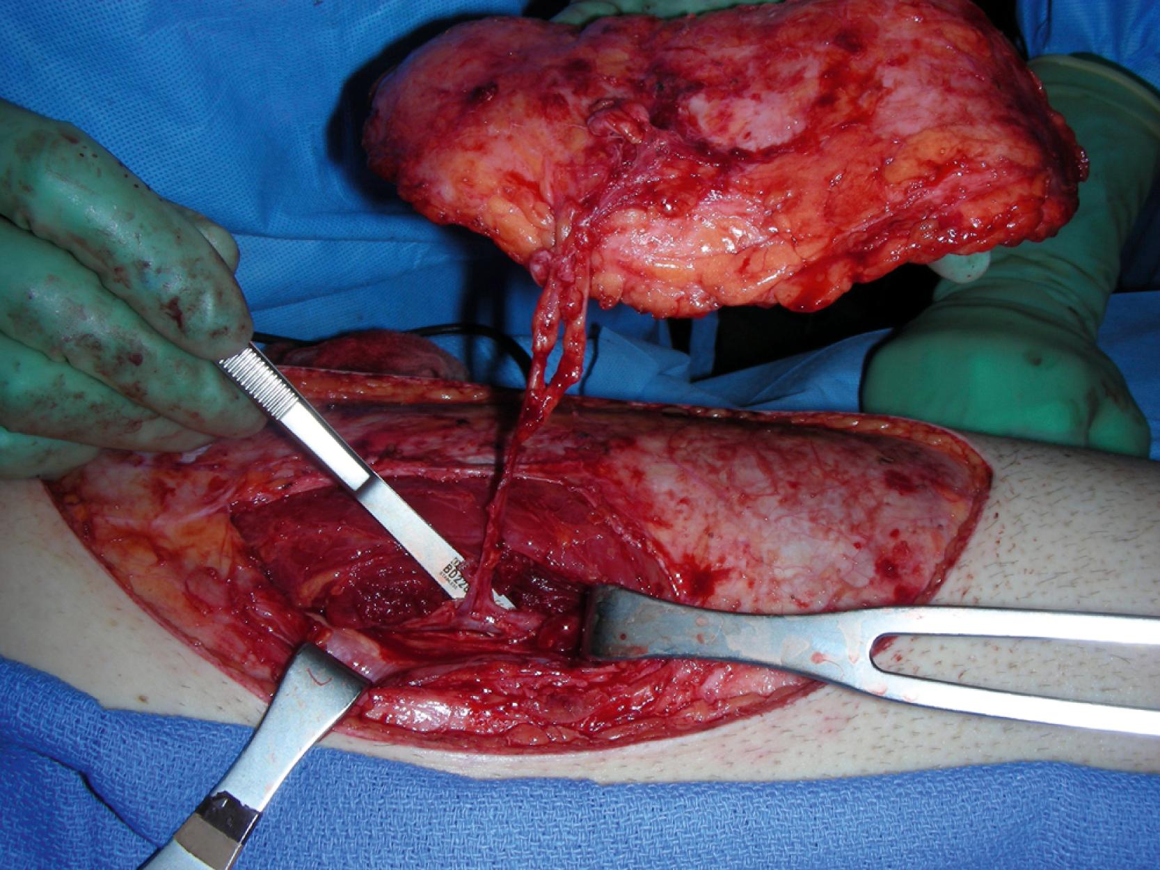 Fig. 49.3, An intraoperative view showing the successful perforator dissection. Both perforators formed a single perforator that joined the descending branch of the lateral circumflex femoral artery.