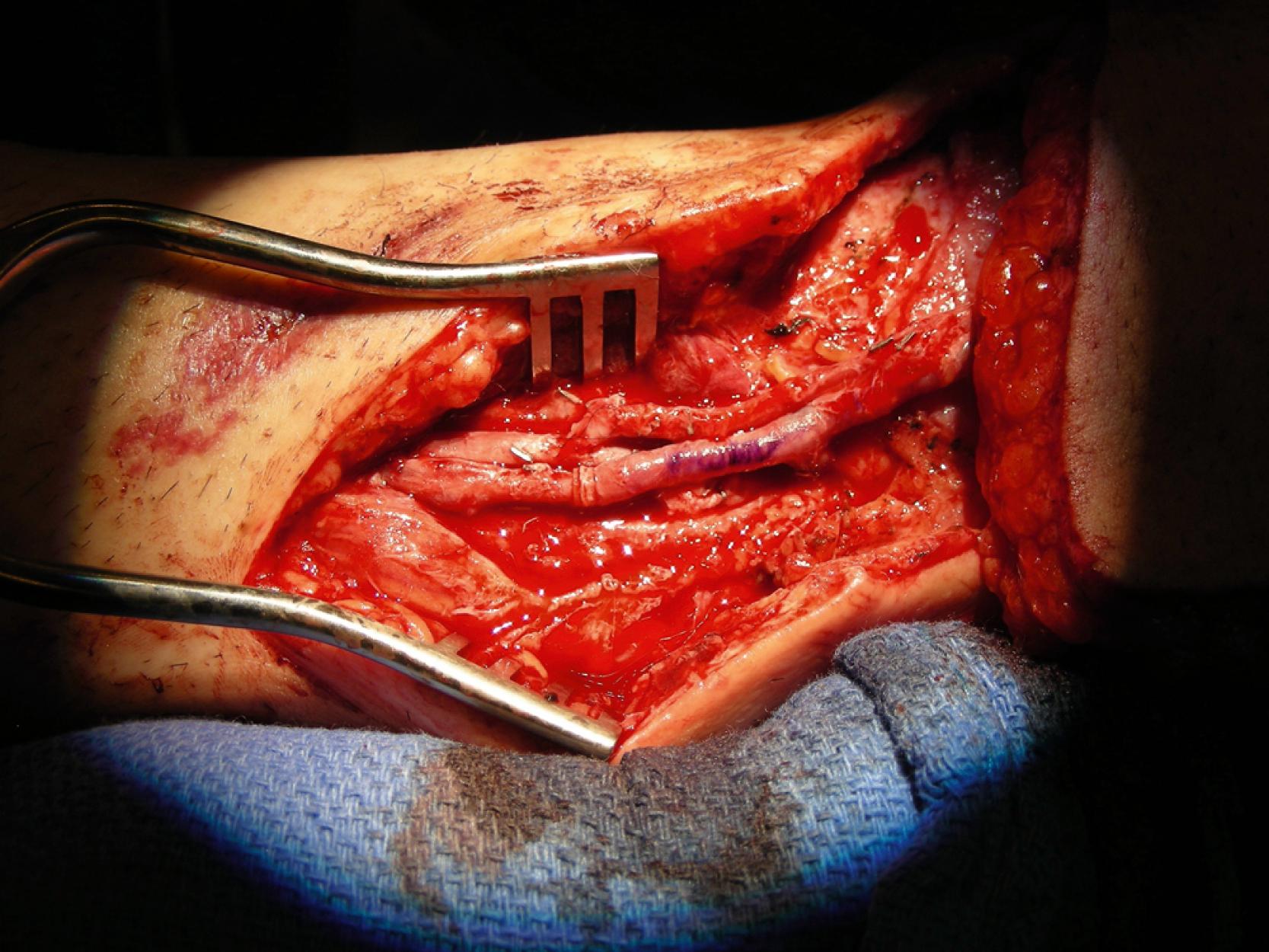 Fig. 49.5, An intraoperative view showing completion of successful microvascular anastomoses. The arterial microanastomosis was end-to-side with 8-0 nylon sutures and the venous microanastomosis was end-to-end with a coupler device.