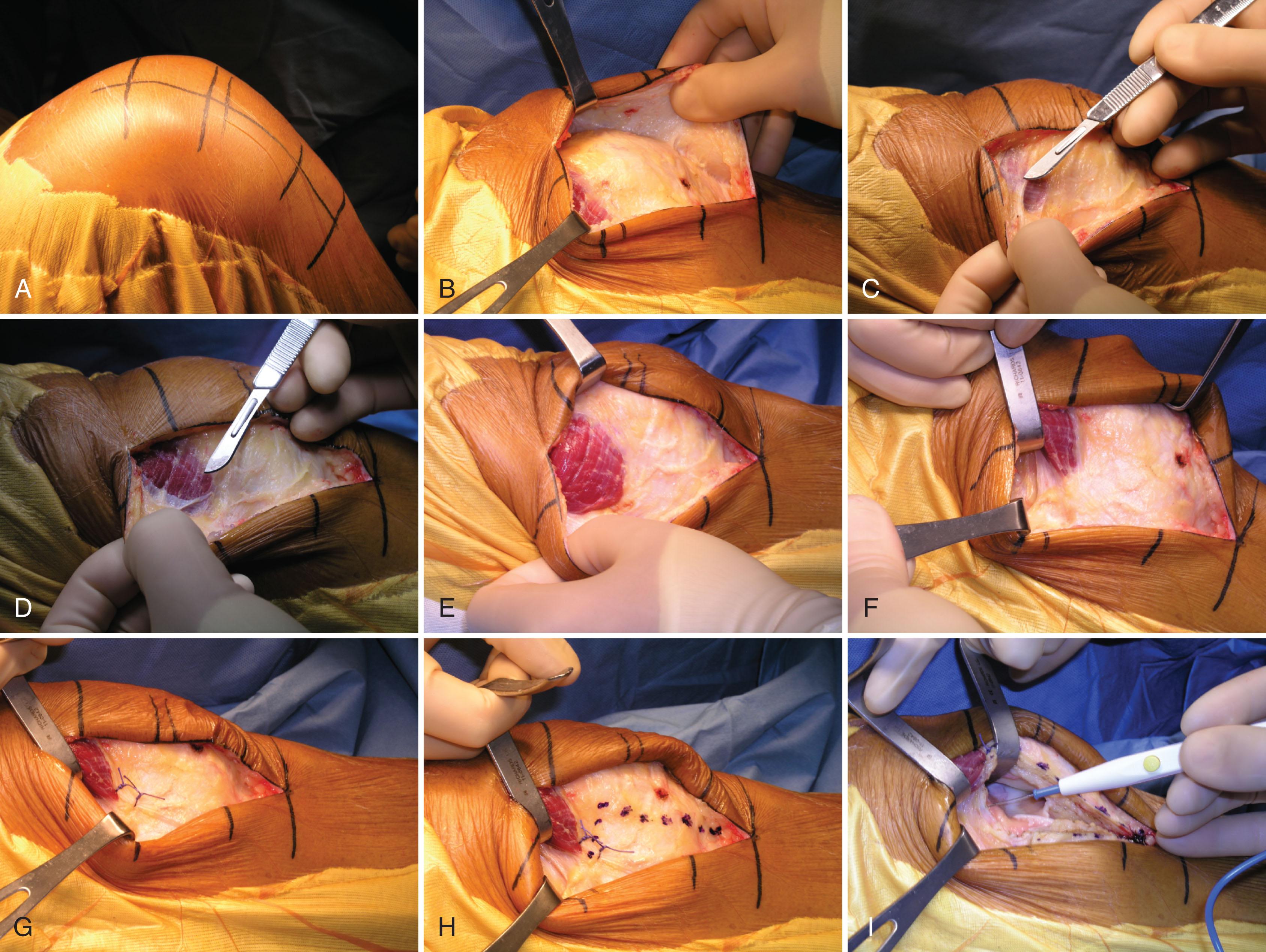 Fig. 15.1, (A) Typical skin incision extending from superior pole of patella to tibial tubercle. (B) Development of medial and lateral full-thickness subcutaneous flaps. (C) Exposure of vastus medialis obliquus (VMO) insertion. (D) Subfascial dissection of VMO. (E) Complete exposure of distal VMO insertion. (F) Placement of Z-retractor underneath distal VMO. Note insertion on patella is left completely intact. (G) Tagging sutures marking distal extent of insertion of VMO on patella. (H) Proposed line of incision for performing medial arthrotomy. (I) Release of synovial attachments from femur to undersurface of quadriceps from medial to lateral. The superior retractor is placed above the synovial attachments and the inferior retractor is intraarticular. This clearly delineates the synovial tissue that must be released to mobilize the extensor mechanism and expose the joint. (J) Exposure of articular surfaces. In this example, a medial unicompartmental arthroplasty is being performed. During total knee arthroplasty, we routinely place a knurled pin in the patellar tendon insertion to protect it from detachment during the case. (K) Standard closure of the arthrotomy. The VMO is left completely intact.