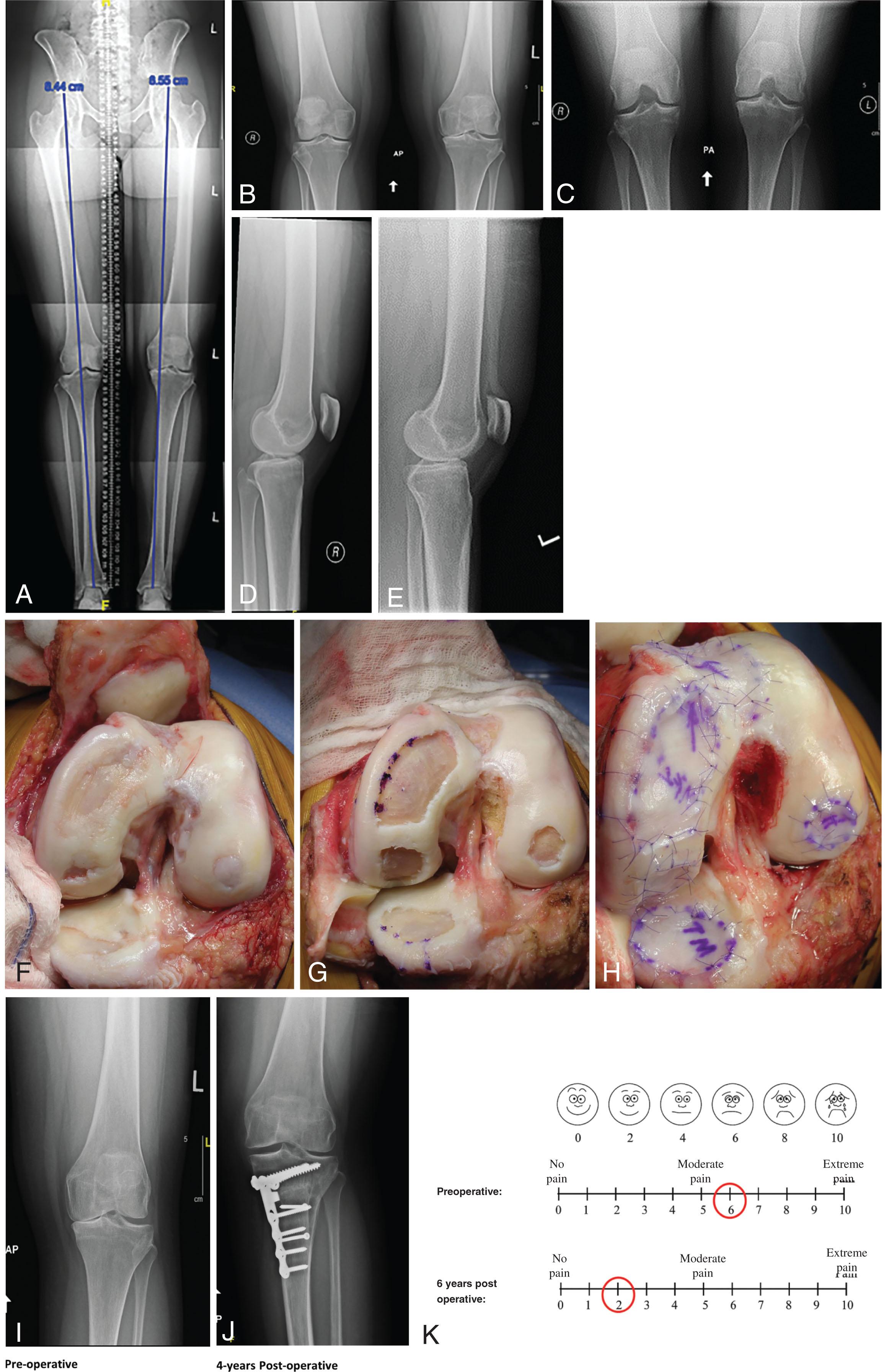 Fig. 15.2, (A) Long alignment x-ray image demonstrates weight-bearing axis to fall through the center of the medial joint compartment. (B) Standing AP x-ray image demonstrates loss of joint space anterior in the medial compartment. (C) Standing PA x-ray image demonstrates well-preserved posterior medial joint compartment. (D and E) Well-preserved patellofemoral joint space of both knees. (F) Large articular defects noted on the medial femoral condyle, medial tibial plateau, lateral femoral condyle, and trochlea. The exposure is facilitated by a tibial tubercle osteotomy that has been flipped up and a takedown of the medial meniscus. (G) Radical debridement of all the articular cartilage is performed back to stable intact full-thickness cartilage. The blue dots represent the location of transosseous drill holes made to secure the collagen membrane and chondrocytes using a small C-wire on a wire driver. The sutures are passed by straightening out the P3 cutting needle with a needle driver. (H) Final appearance of c-ACI after microsuturing, sealing the areas with fibrin glue, and injecting autologous cultured chondrocytes to fill the defects. The medial meniscus is then brought back to the intermeniscal ligament in near full extension and repaired with transosseous sutures through the medial meniscus anteriorly through the metaphyseal bone with a tapered needle no. 1 Vicryl suture. The tibial tubercle is then repositioned to center patellar tracking and fixated with two anterior to posterior lag screws followed by the medial patellofemoral ligament reattached to the mid-patellar pole and the lateral retinaculum being lengthened. Postoperative range of motion is instituted the morning after surgery using patellar mobilizations with manual therapy and a continuous passive motion machine. Touch weight-bearing for 6 weeks was followed by progressive weight-bearing to full body weight at 10 weeks with a medial compartment unloader braces. Because of the lateral femoral condyle defect the axial alignment is not overcorrected into the lateral compartment but just brought back to the midline. (I) Preoperative standing AP x-ray image shows loss of the anterior medial joint space with bone-on-bone changes. (J) Four-year postoperative weight-bearing x-ray image showing complete restoration of the medial joint compartment. It is a full weight-bearing AP x-ray image with mechanical axis corrected to the midline and not into the lateral compartment because of the lateral femoral condyle transplant. (K) VAS scores preoperative and postoperative.