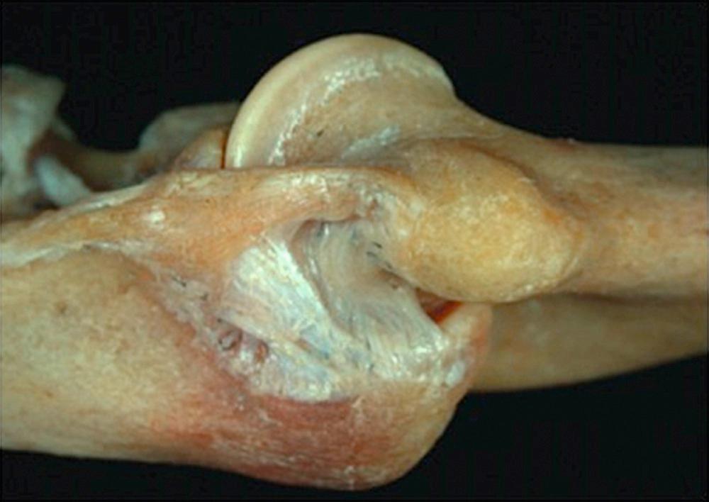 FIG 36.2, The anterior bundle of the medial collateral ligament originates from the anterior inferior aspect of the medial epicondyle and inserts on the sublime tubercle. It is the primary stabilizer to resist valgus stress.