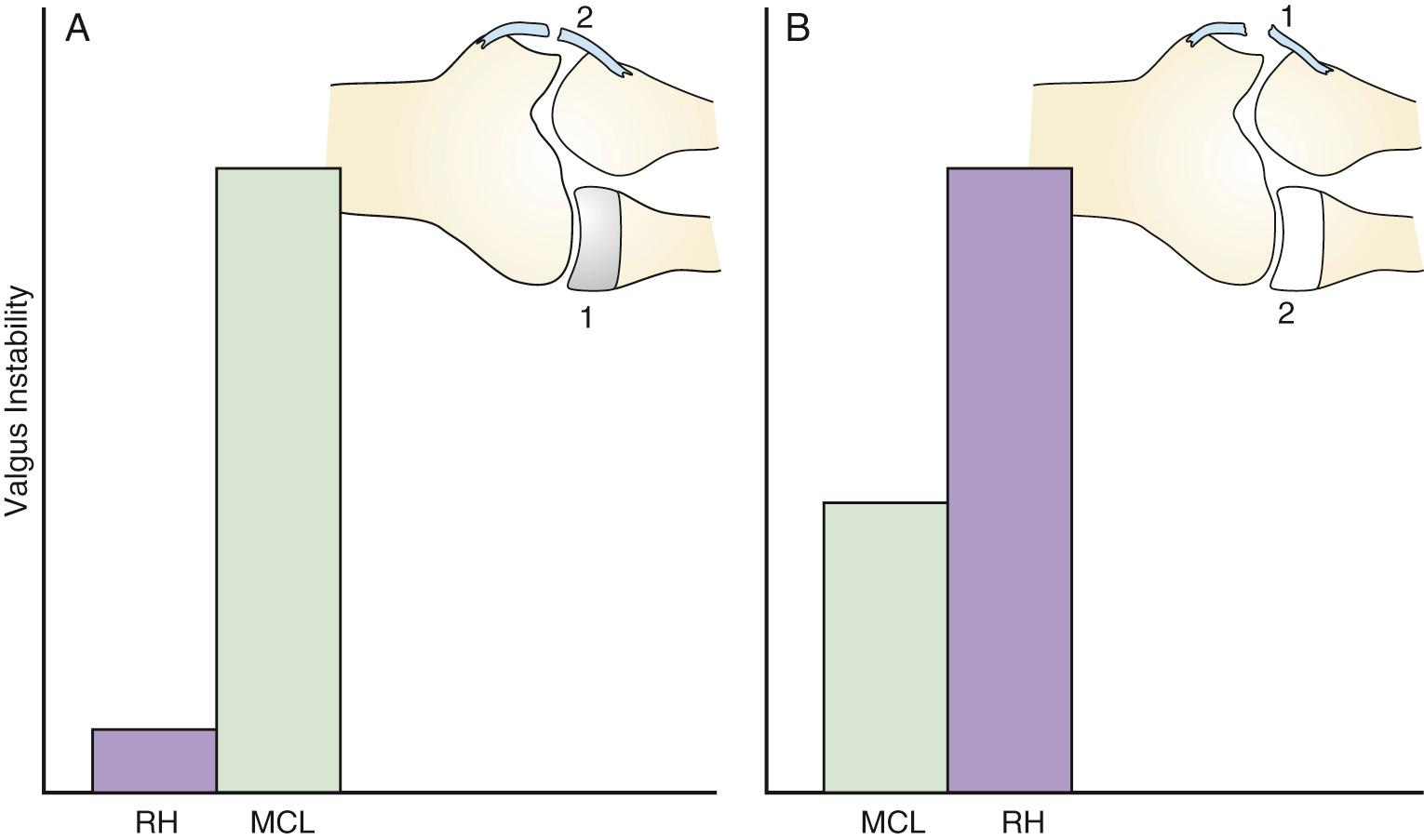 FIG 36.3, (A) Demonstration of the radial head as a secondary stabilizer when the medial collateral ligament is intact and the radial head may be removed (1). However, if the medial collateral ligament is released (2) after the radial head has been resected, marked instability occurs. (B) The alternative situation is one in which the radial head is left intact. In this setting, when the medial collateral ligament is resected (1), some instability occurs but the gross instability is seen only when the radial head has been removed (2), thus the designation of the radial head as a secondary stabilizer.