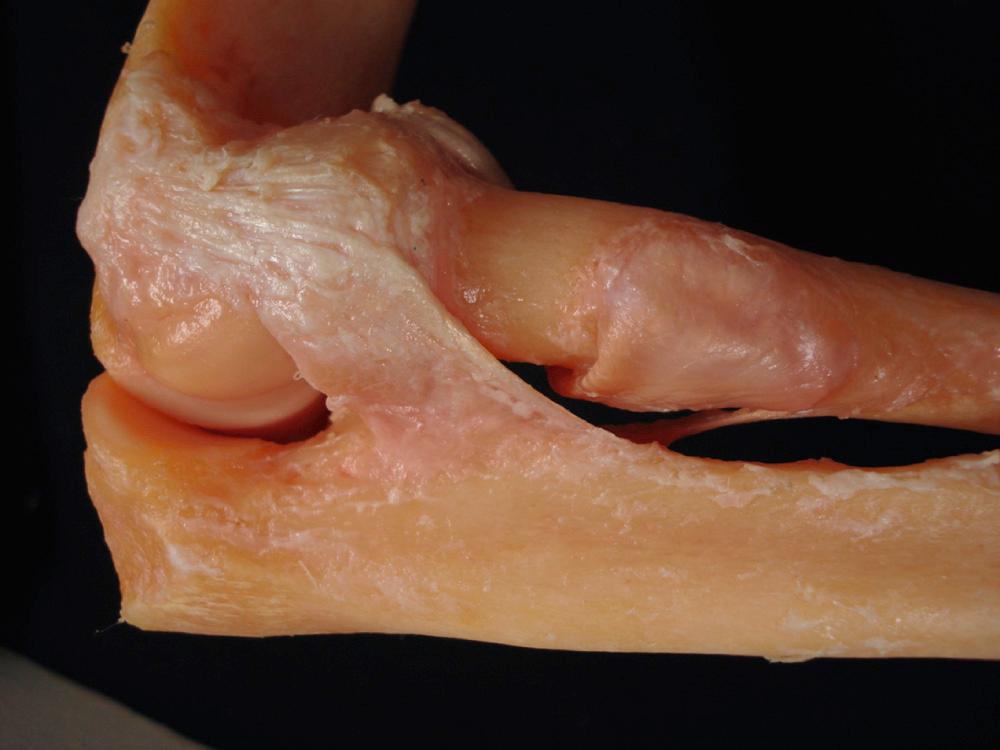 FIG 36.4, The lateral ulnar collateral ligament originates from the lateral epicondyle as a component of the radial collateral ligament complex. It inserts on the supinator crest and is the major source of resistance to posterior lateral rotatory instability.