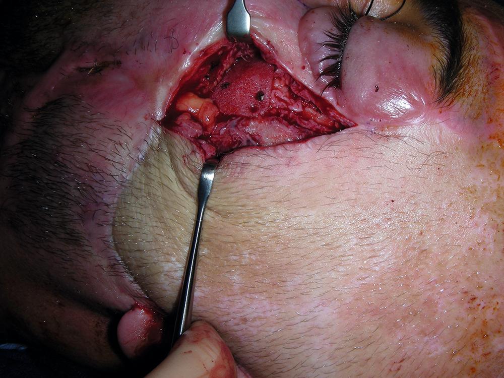 Fig. 10.13, Intraoperative view showing placement of a Medpor implant for the midfacial augmentation. In this way, the malposition of the patient’s left lower eyelid might be improved.