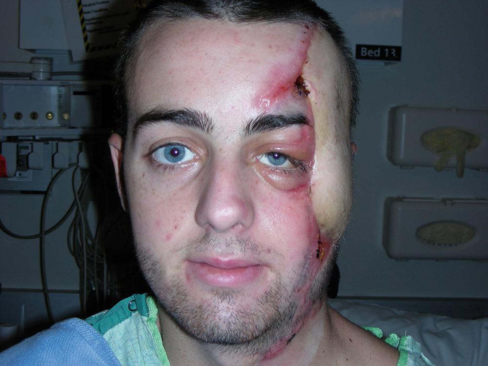 Fig. 10.8, (A) and (B), The result at 5-week follow-up after the initial free ALT perforator flap reconstruction and bony reconstruction with Medpor implants and titanium plates.